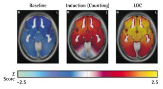 Masimo - Diagramma del cambiamento di potenza EEG che mostra le variazioni di potenza EEG al momento dell'induzione e della perdita di coscienza
