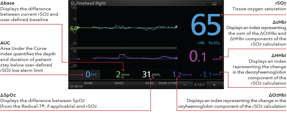 Masimo - Display O3 ossimetria cerebrale