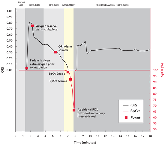 Masimo - Diagramma applicazione clinica di ORi