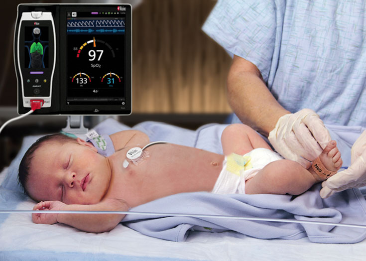 Masimo - Applicazione del sensore RAS sul piede destro di neonati